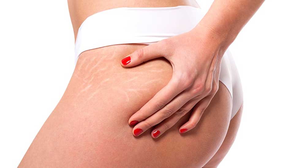 Embracing Your Body: Understanding Stretch Marks, Causes